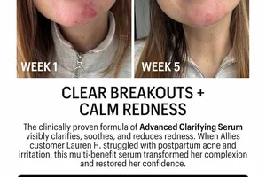 Visibly Improve Redness + Acne ✨